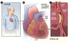 冠心病的起因是什么？