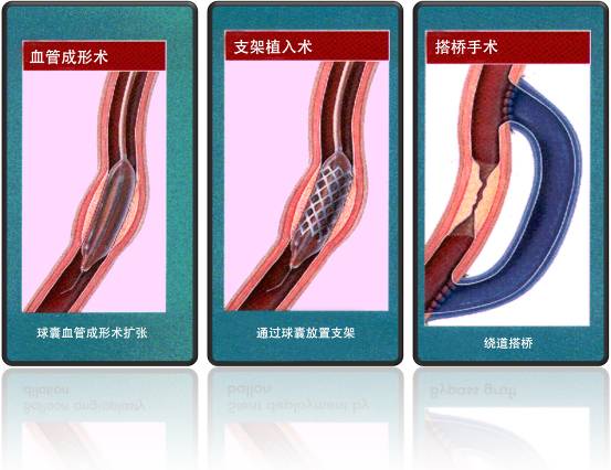 怎樣治療冠心病？(圖1)