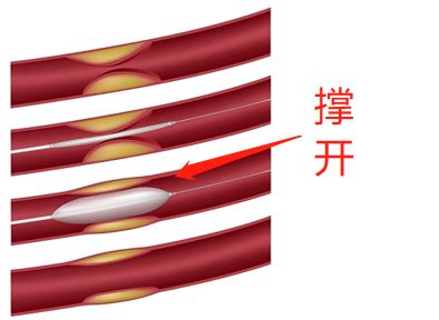 什么是藥物球囊？(圖2)